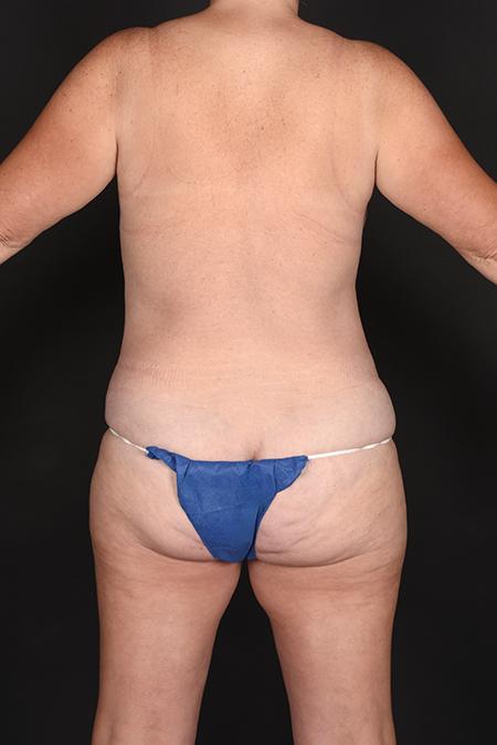 Before image 4 Case #128961 - Mommy Makeover - Mastopexy and Abdominoplasty