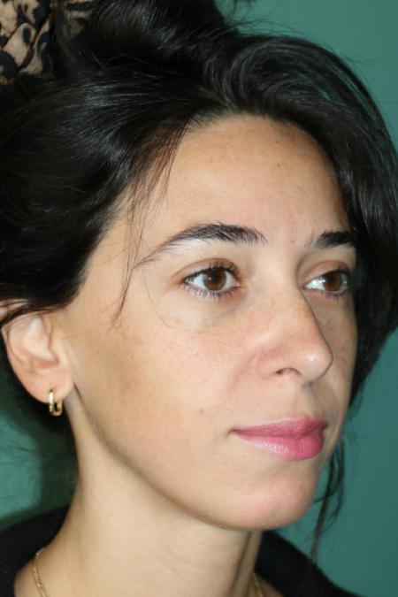 After image 2 Case #128881 - Primary Rhinoseptoplasty