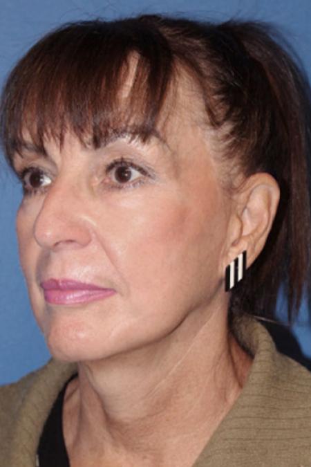 After image 2 Case #129041 - Facial Rejuvenation