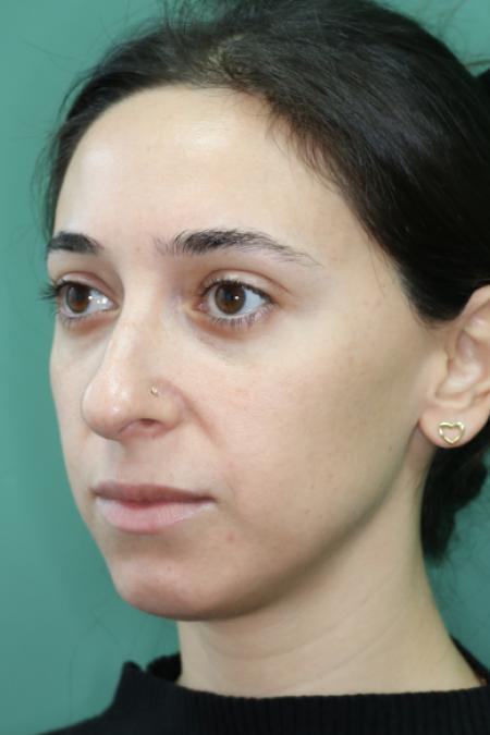 Before image 3 Case #128881 - Primary Rhinoseptoplasty