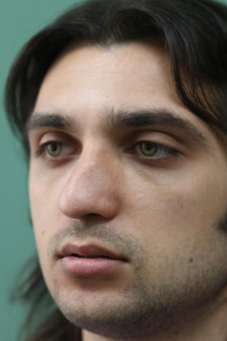 Before image 3 Case #128871 - Primary Septorhinoplasty