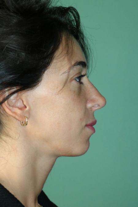 After image 5 Case #128881 - Primary Rhinoseptoplasty