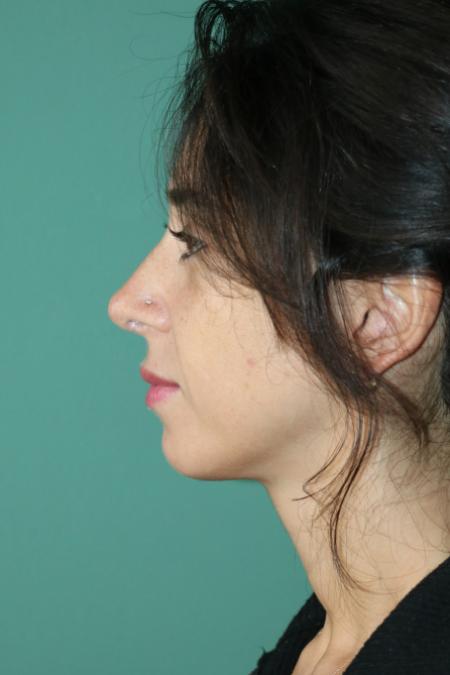 After image 4 Case #128881 - Primary Rhinoseptoplasty