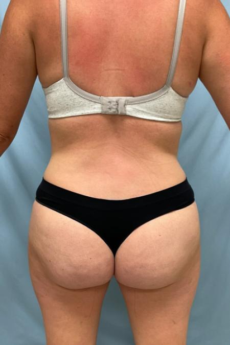 After image 3 Case #129106 - 39 y.o. female w/ Tummy Tuck, Lipo & Fat Transfer