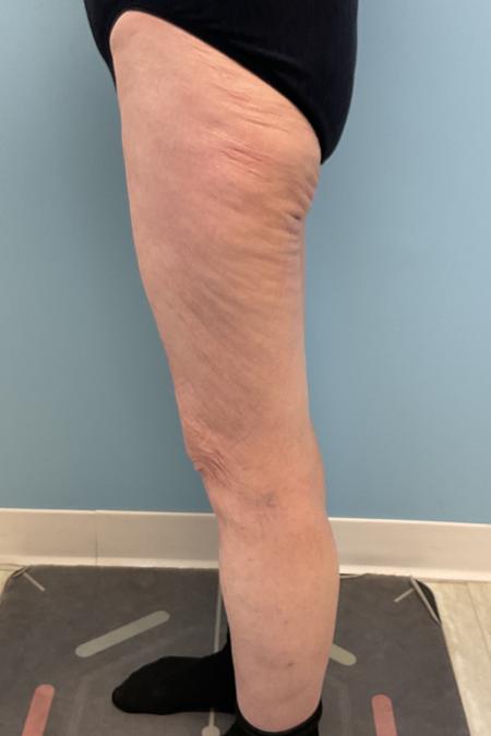 After image 3 Case #128241 - 66 y.o. female w/ Thigh Lift & Lipo Thighs & Calf