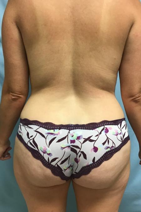 Before image 3 Case #129106 - 39 y.o. female w/ Tummy Tuck, Lipo & Fat Transfer