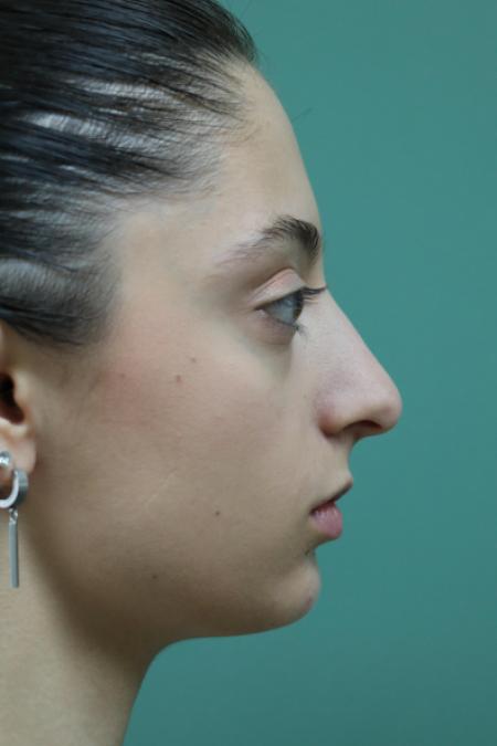 Before image 4 Case #128876 - Primary Rhinoseptoplasty