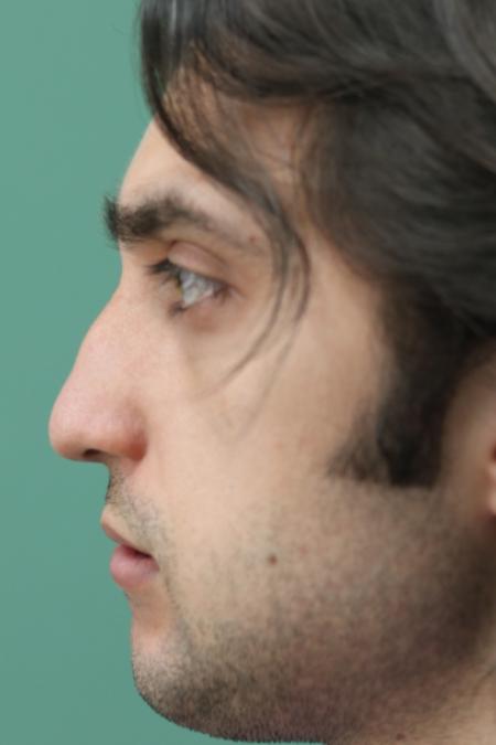 Before image 5 Case #128871 - Primary Septorhinoplasty