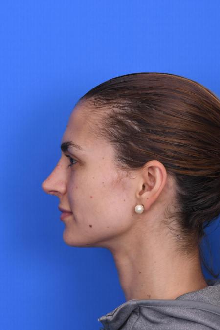 After image 2 Case #129951 - RHINOPLASTY
