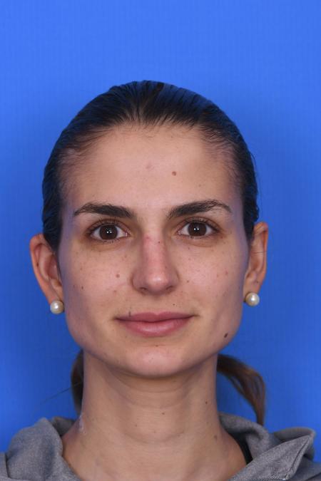 After image 1 Case #129951 - RHINOPLASTY