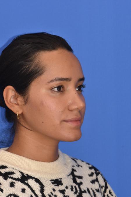 After image 5 Case #129946 - RHINOPLASTY