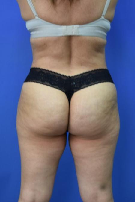 After image 5 Case #129716 - Tummy tuck with BBL