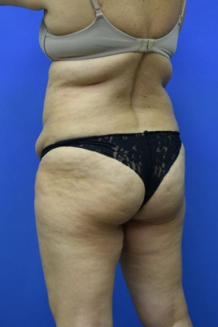 Before image 4 Case #129716 - Tummy tuck with BBL