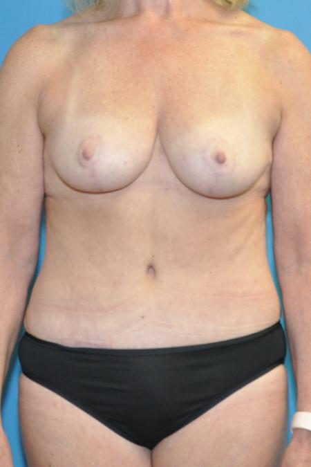 After image 1 Case #130151 - Mommy Makeover