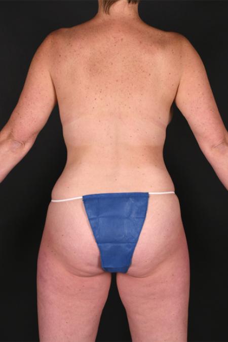 After image 4 Case #128936 - Mommy Makeover - Augmentation Mastopexy 