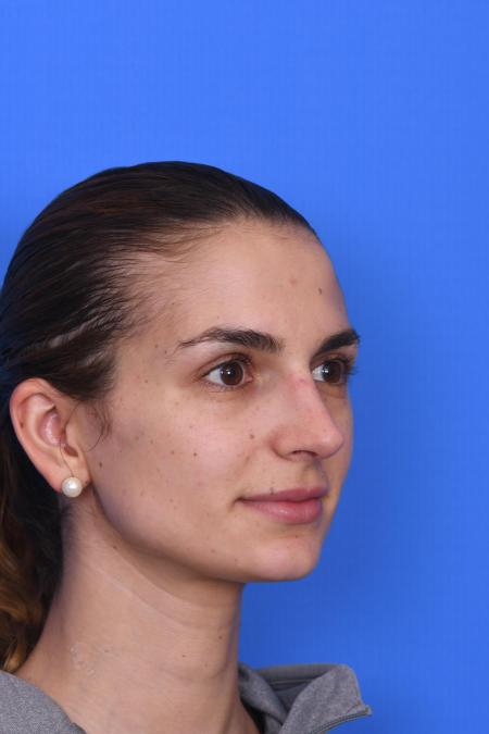 After image 4 Case #129951 - RHINOPLASTY