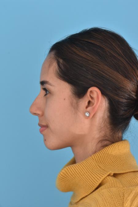 Before image 3 Case #130026 - PRIMARY RHINOPLASTY