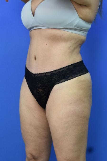 After image 2 Case #129716 - Tummy tuck with BBL