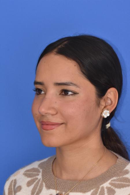 After image 2 Case #129946 - RHINOPLASTY