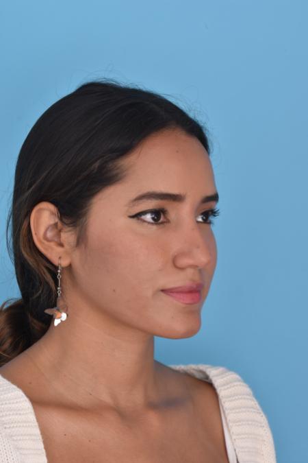 Before image 5 Case #129946 - RHINOPLASTY