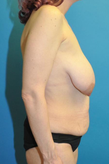 Before image 3 Case #130136 - Mommy Makeover