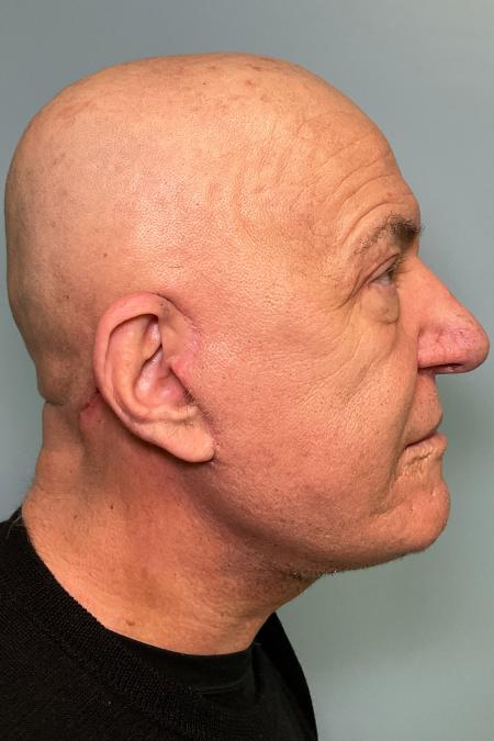 After image 2 Case #129916 - 64 y.o. male with Face and Necklift