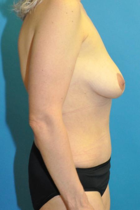 After image 3 Case #130136 - Mommy Makeover