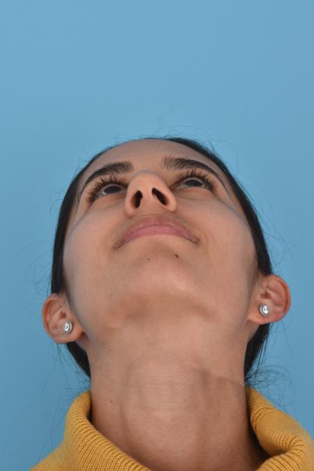 Before image 5 Case #130026 - PRIMARY RHINOPLASTY