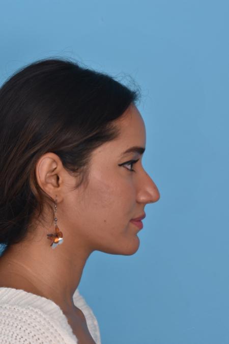 Before image 3 Case #129946 - RHINOPLASTY