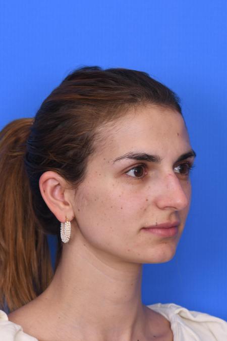 Before image 4 Case #129951 - RHINOPLASTY