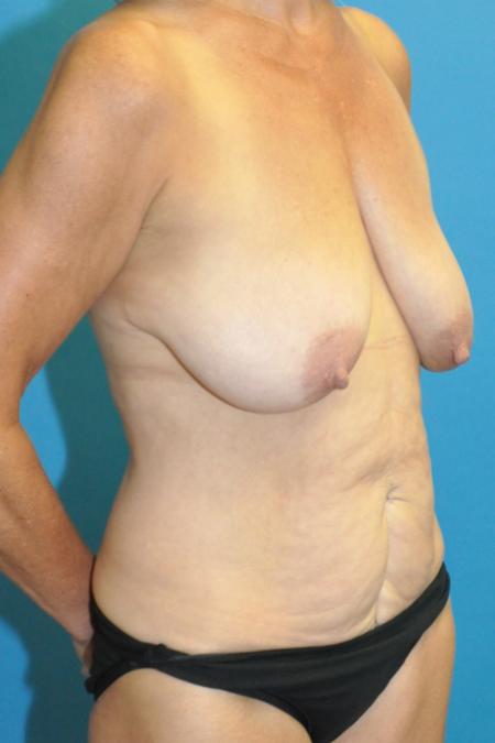 Before image 2 Case #130141 - Mommy Makeover