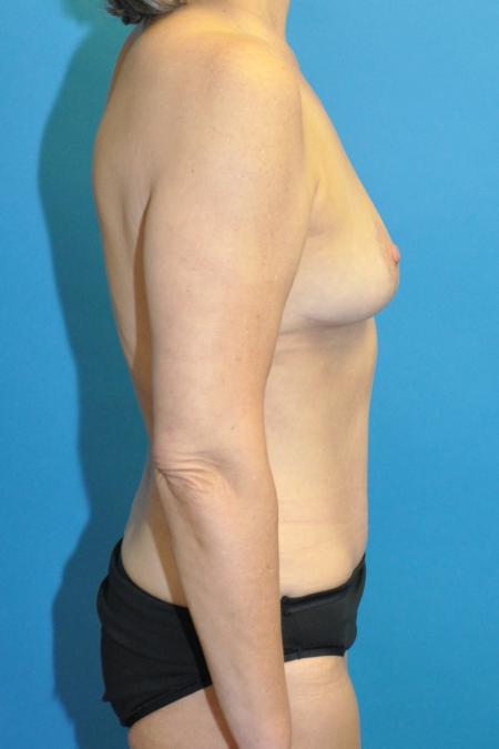 After image 3 Case #130141 - Mommy Makeover