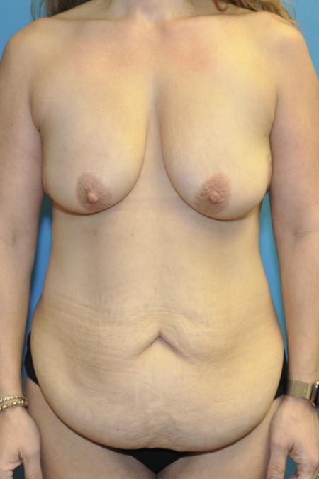 Before image 1 Case #130131 - Mommy Makeover