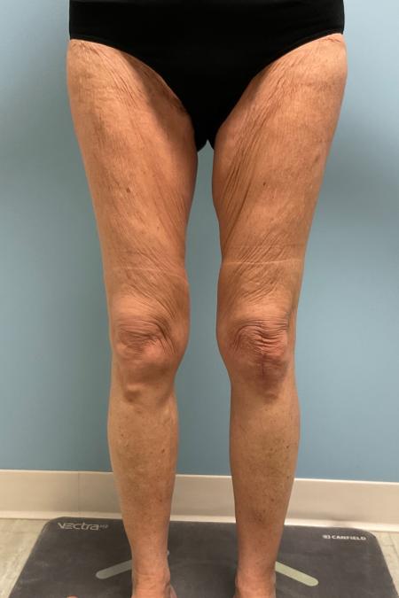 Before image 1 Case #129816 - 68 y.o female with Thigh Lift and Lipo