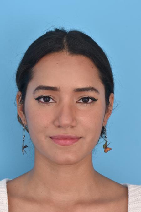 Before image 1 Case #129946 - RHINOPLASTY