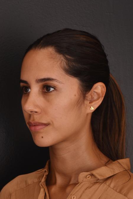 After image 2 Case #130026 - PRIMARY RHINOPLASTY