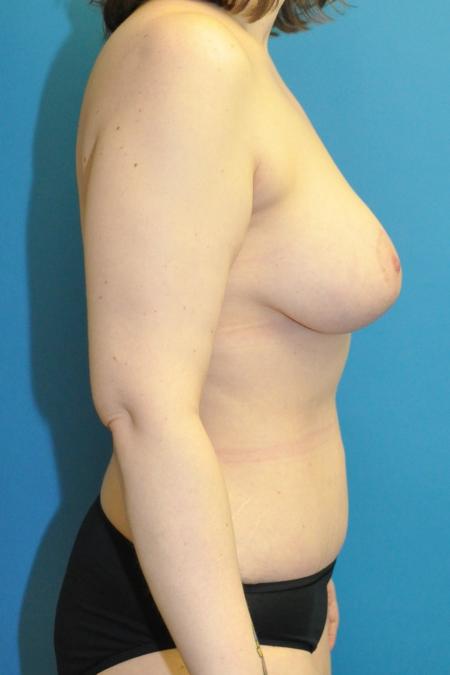 After image 3 Case #130146 - Mommy Makeover