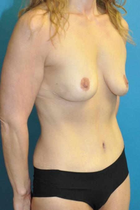After image 2 Case #130131 - Mommy Makeover