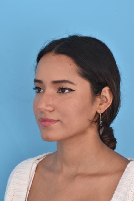 Before image 2 Case #129946 - RHINOPLASTY