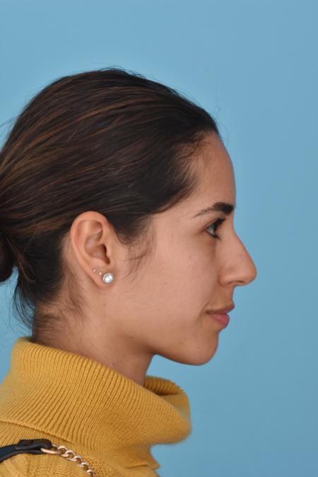 Before image 4 Case #130026 - PRIMARY RHINOPLASTY