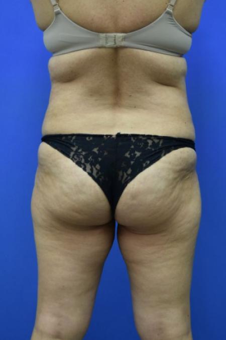 Before image 5 Case #129716 - Tummy tuck with BBL