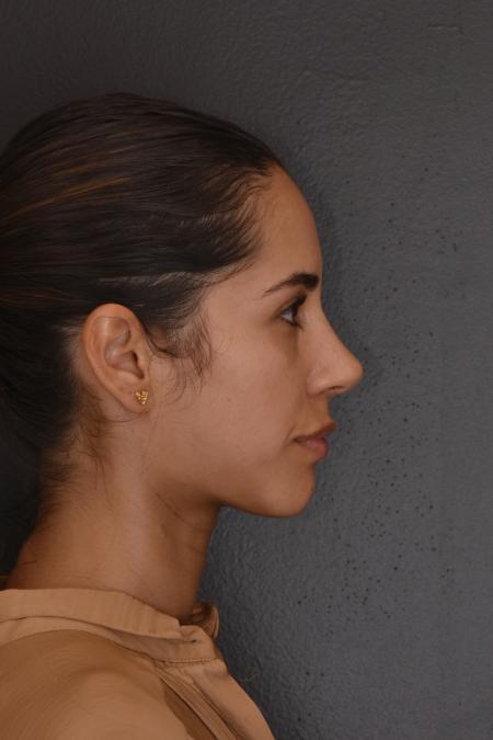 After image 4 Case #130026 - PRIMARY RHINOPLASTY