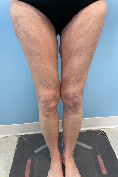 After image 1 Case #129816 - 68 y.o female with Thigh Lift and Lipo