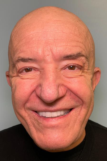 After image 1 Case #129916 - 64 y.o. male with Face and Necklift