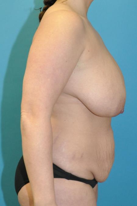 Before image 3 Case #130156 - Mommy Makeover