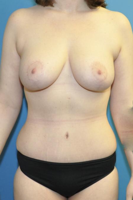 After image 1 Case #130146 - Mommy Makeover