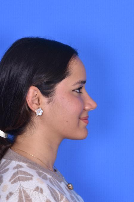 After image 3 Case #129946 - RHINOPLASTY