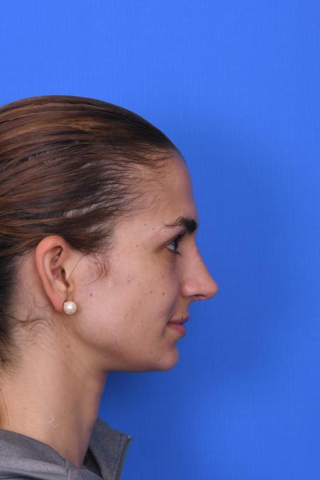 After image 3 Case #129951 - RHINOPLASTY