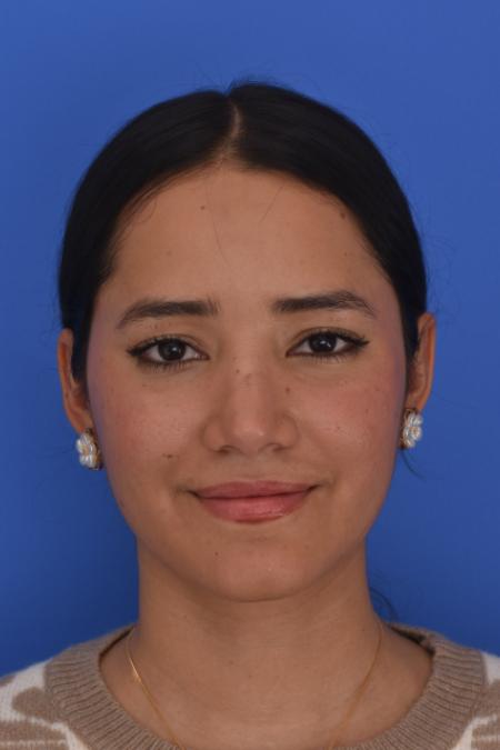 After image 1 Case #129946 - RHINOPLASTY