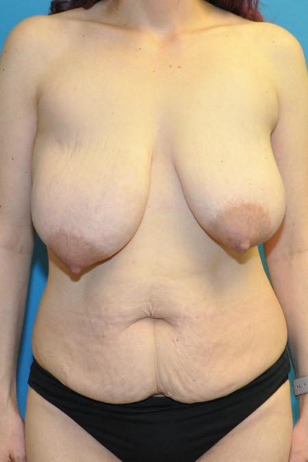Before image 1 Case #130136 - Mommy Makeover